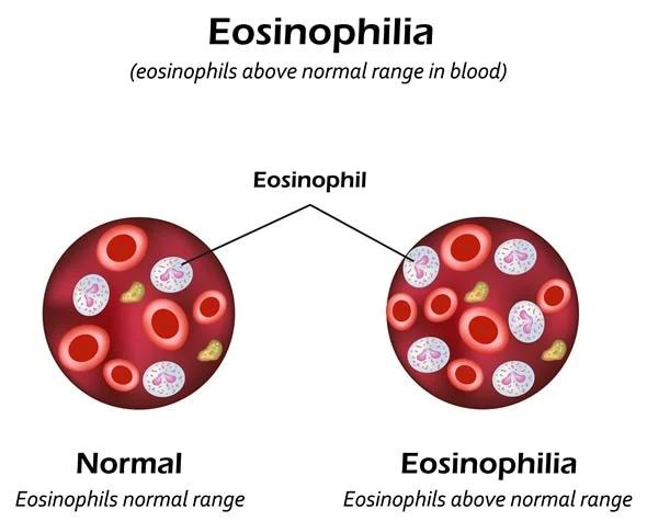 eosinophils