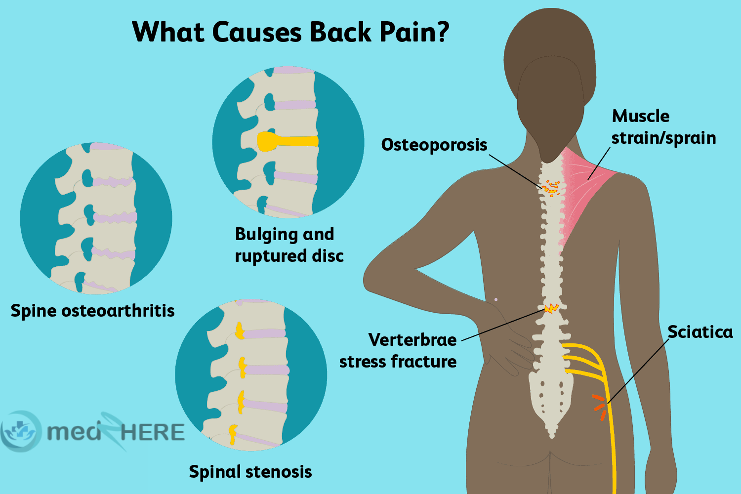 muscle strain